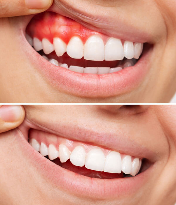 gum-disease-treatment