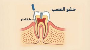 رسم توضيحي لحشو العصب يُظهر تركيب السن، قناة الجذر، وأداة تنظيف الجذر