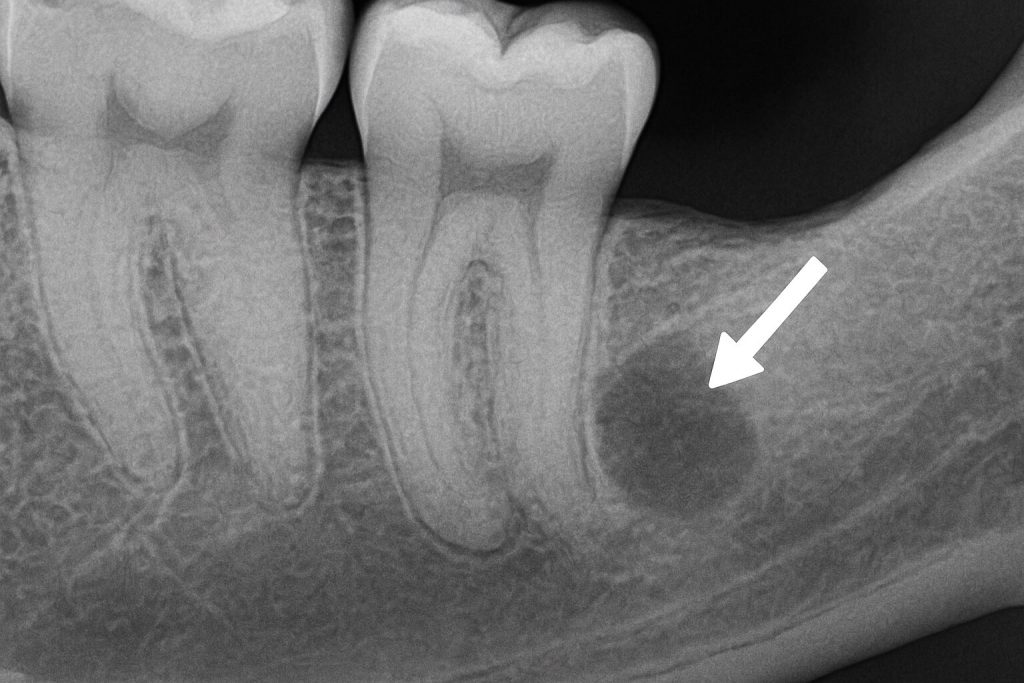 X-ray image of a dental abscess under the molar root, showing a deep infection causing pain when biting—often due to incomplete root canal treatment.