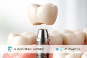 تركيب الأسنان