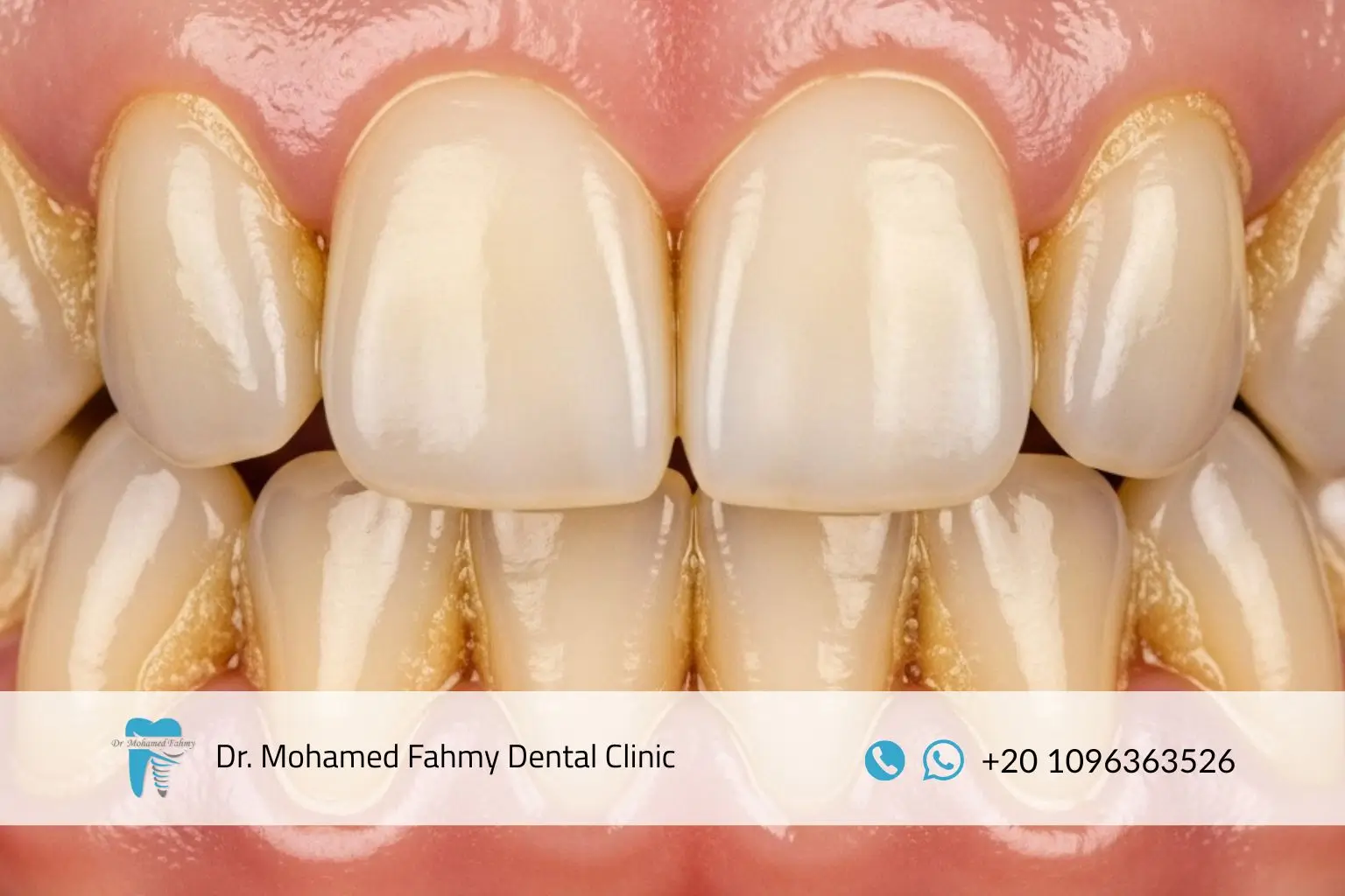 جير الأسنان