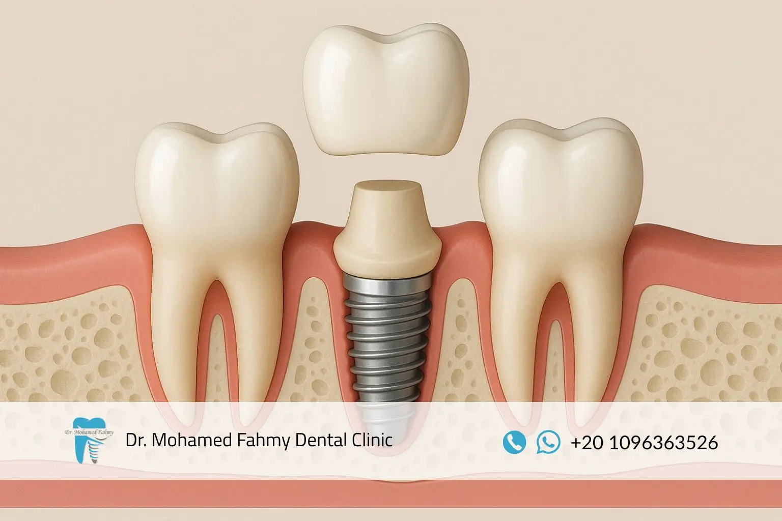 سعر طربوش الأسنان