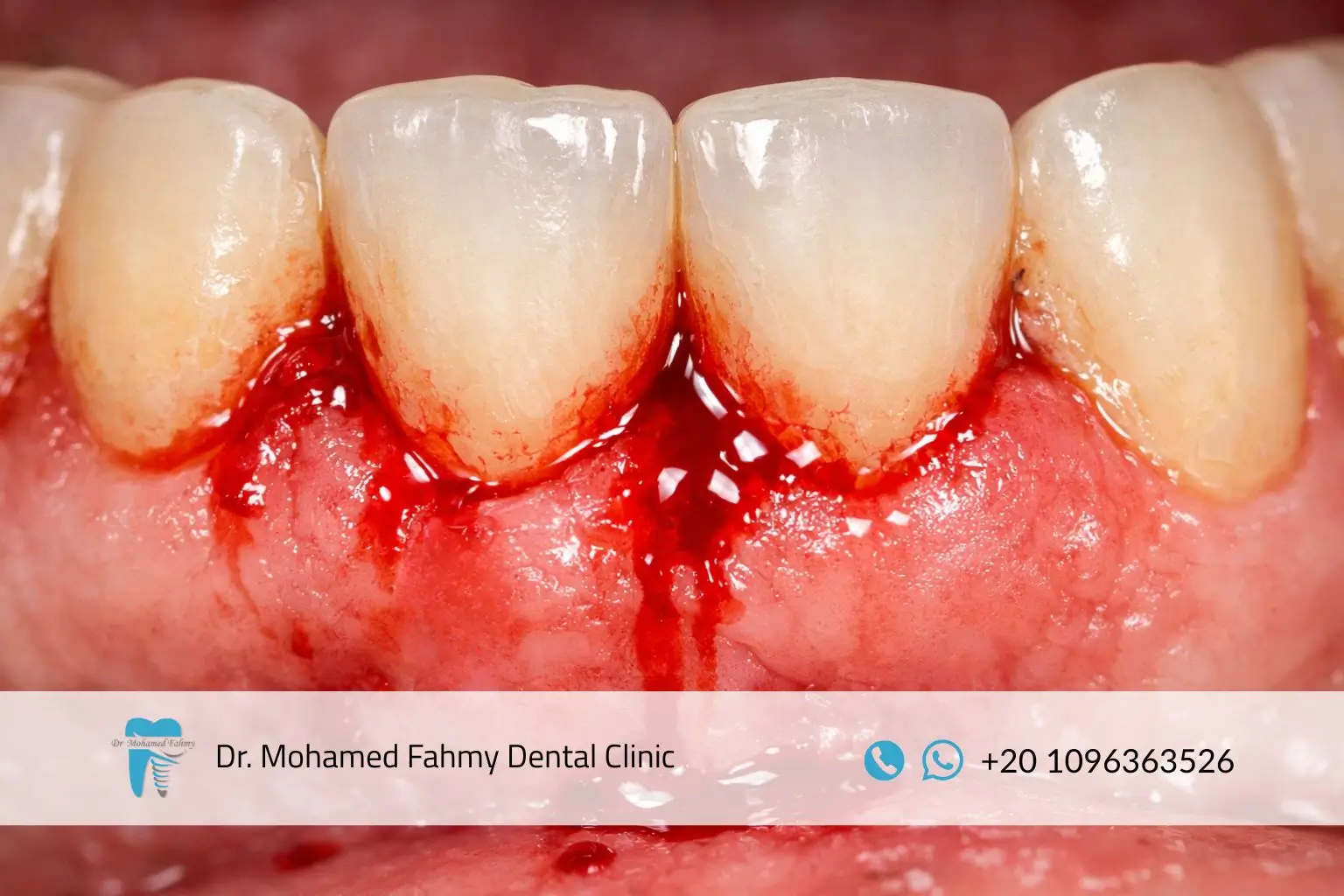 أسباب نزيف اللثة