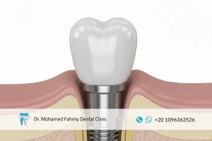 سعر تركيب الأسنان
