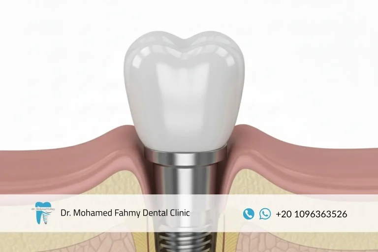 سعر تركيب الأسنان