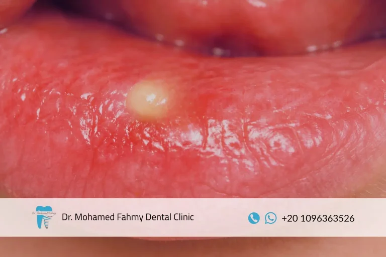 التهاب الفم عند الأطفال