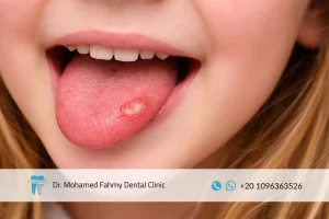 تقرحات اللسان