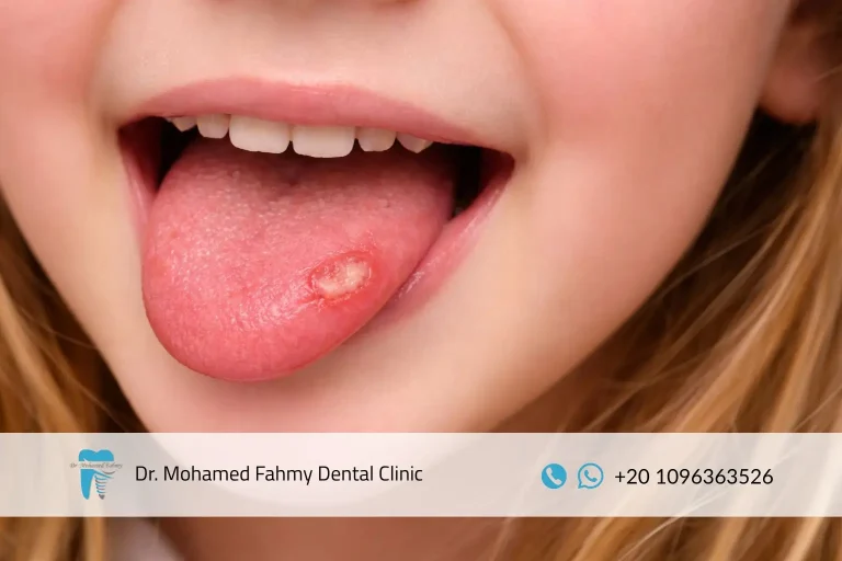 تقرحات اللسان