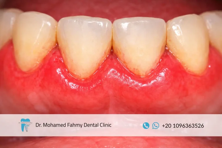 علاج التهاب اللثة للأطفال