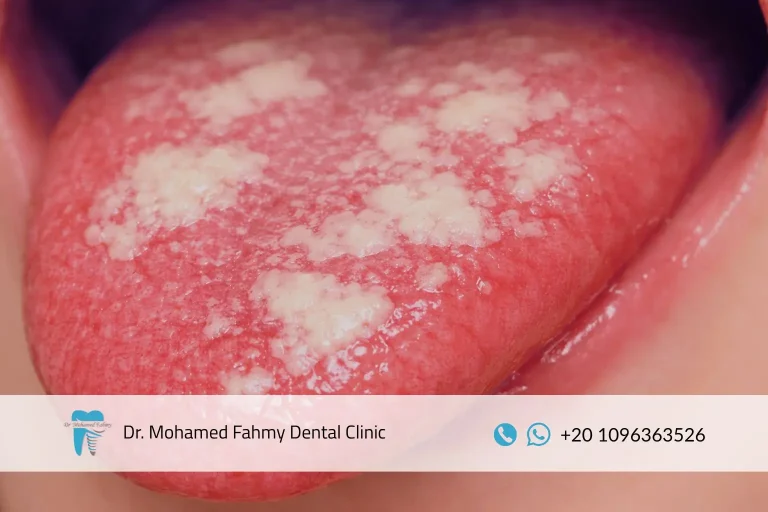 علاج فطريات اللسان للكبار