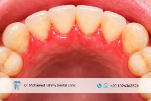 ما هو علاج التهاب اللثة