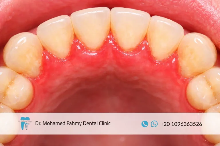 ما هو علاج التهاب اللثة