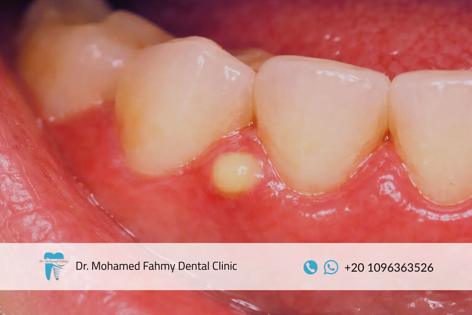 علاج خراج الضرس عند الأطفال