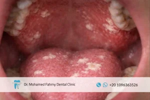 علاج فطريات الفم
